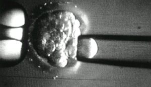 Human cleavage stage embryo from which a single blastomere with a single visible interphase nucleus is being removed by micromanipulation.