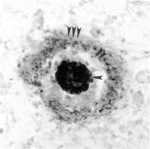 Figure 2: Amyloid plaque as formed in the brain of Alzheimer patients. The major component of the plaque, beta-amyloid peptide, is neurotoxic and contributes to the neurodegeneration process.